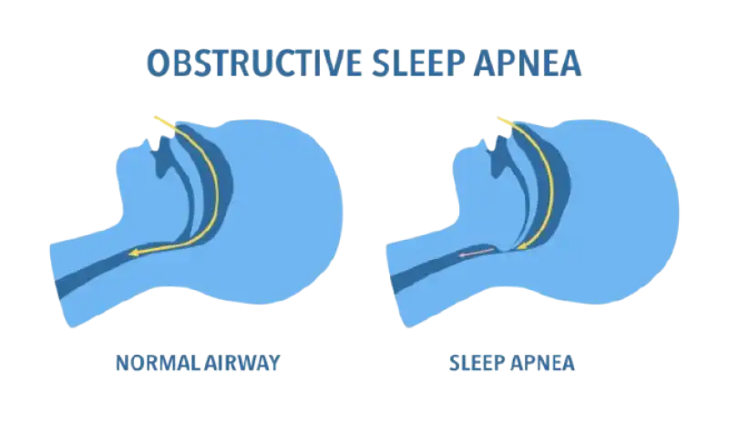 Sleep-Disordered Breathing May Accelerate Biological Aging