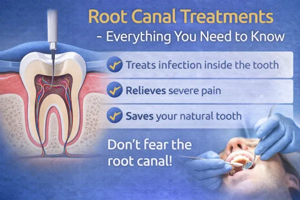 Root Canal Treatments - Everything You Need to Know