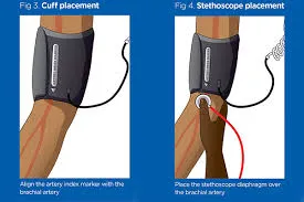Cuff Placement for Blood Pressure
