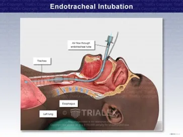 What Is Endotracheal Intubation?