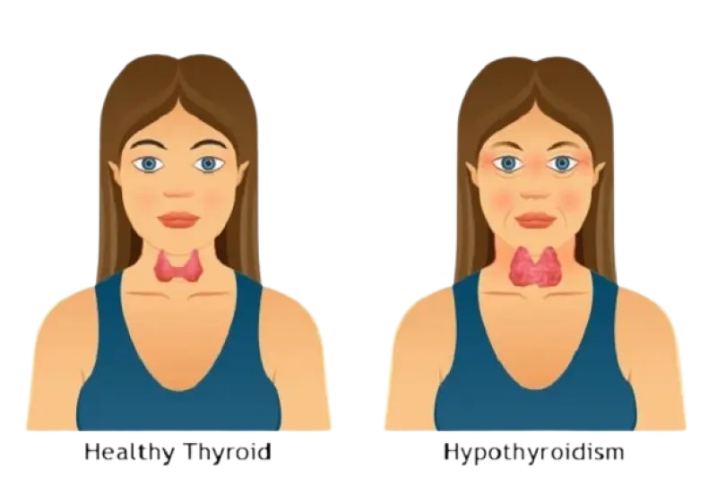 Hypothyroidism: Signs You Might Be Missing